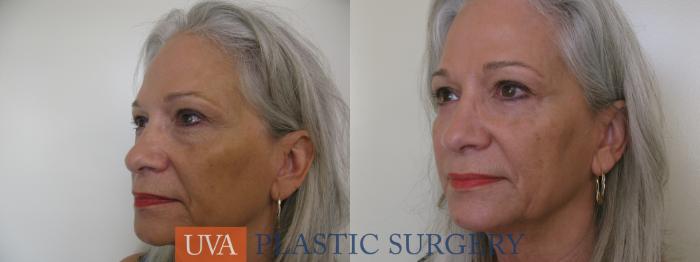 Eyelid Surgery (Blepharoplasty) Case 119 Before & After View #3 | Richmond, Charlottesville & Roanoke, VA | University of Virginia Plastic Surgery