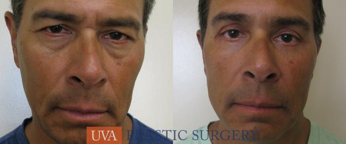 Eyelid Surgery (Blepharoplasty) Case 78 Before & After View #1 | Charlottesville & Fishersville, VA | University of Virginia Plastic Surgery