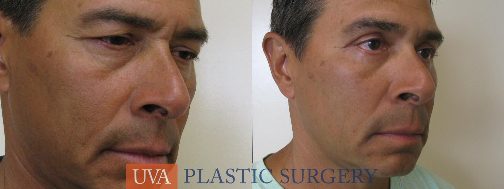 Eyelid Surgery (Blepharoplasty) Case 78 Before & After View #2 | Charlottesville & Fishersville, VA | University of Virginia Plastic Surgery