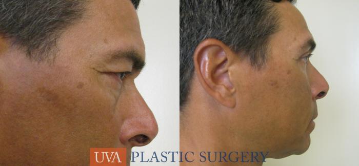 Eyelid Surgery (Blepharoplasty) Case 78 Before & After View #3 | Charlottesville & Fishersville, VA | University of Virginia Plastic Surgery