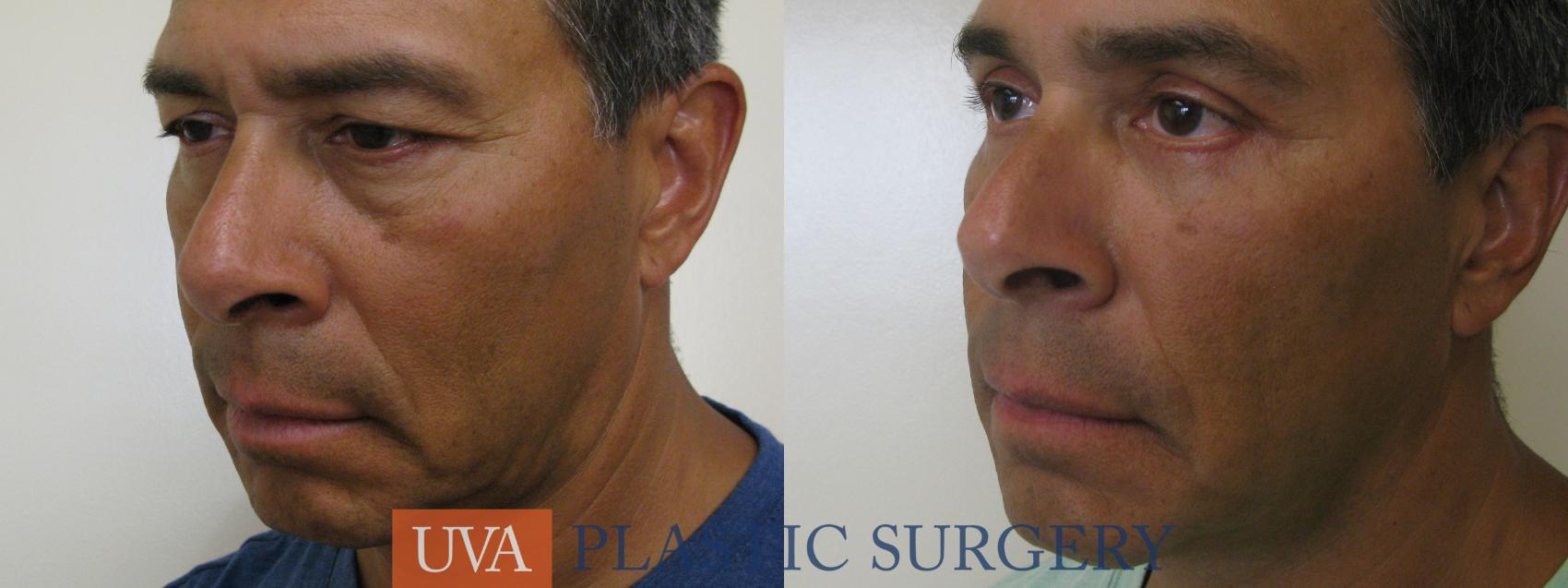 Eyelid Surgery (Blepharoplasty) Case 78 Before & After View #4 | Charlottesville & Fishersville, VA | University of Virginia Plastic Surgery