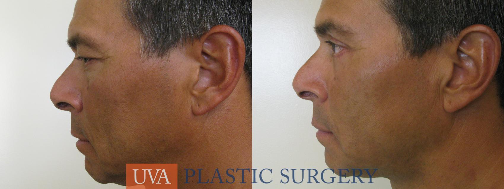 Eyelid Surgery (Blepharoplasty) Case 78 Before & After View #5 | Charlottesville & Fishersville, VA | University of Virginia Plastic Surgery