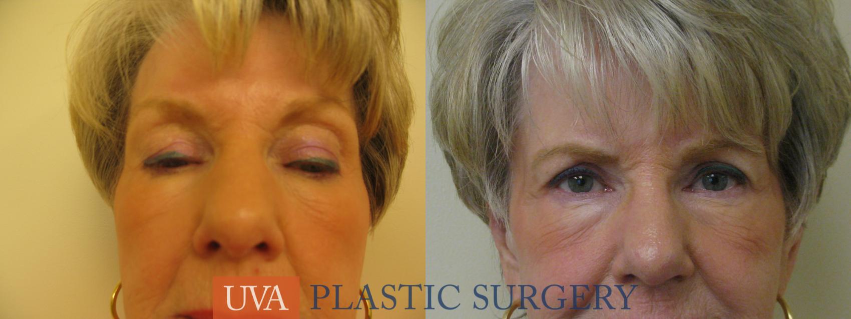Eyelid Surgery (Blepharoplasty) Case 84 Before & After View #1 | Charlottesville & Fishersville, VA | University of Virginia Plastic Surgery