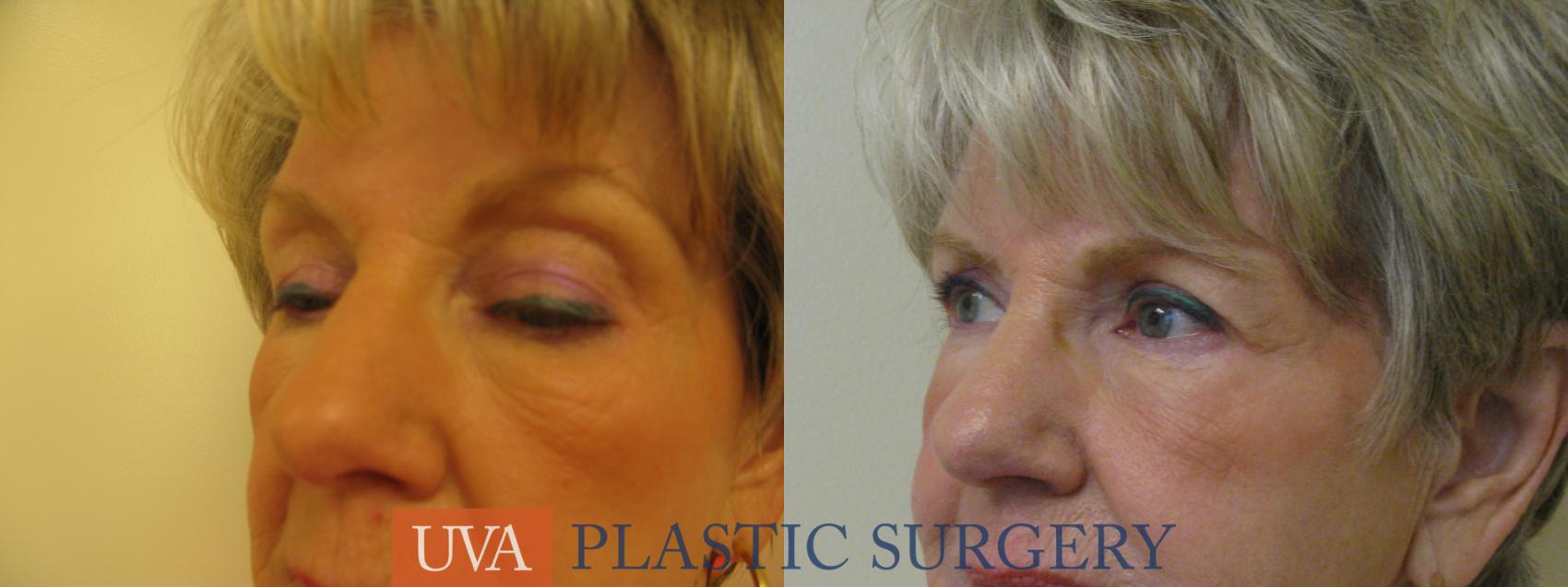 Eyelid Surgery (Blepharoplasty) Case 84 Before & After View #2 | Charlottesville & Fishersville, VA | University of Virginia Plastic Surgery