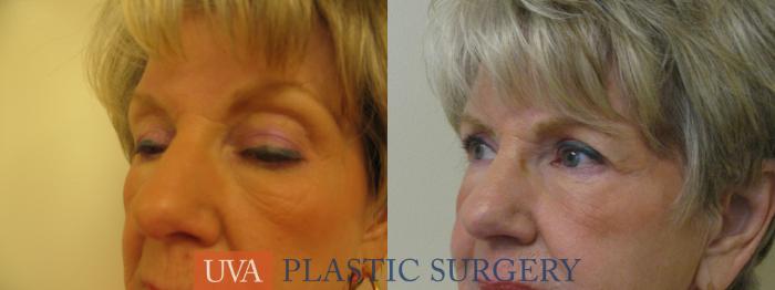 Eyelid Surgery (Blepharoplasty) Case 84 Before & After View #2 | Richmond, Charlottesville & Roanoke, VA | University of Virginia Plastic Surgery