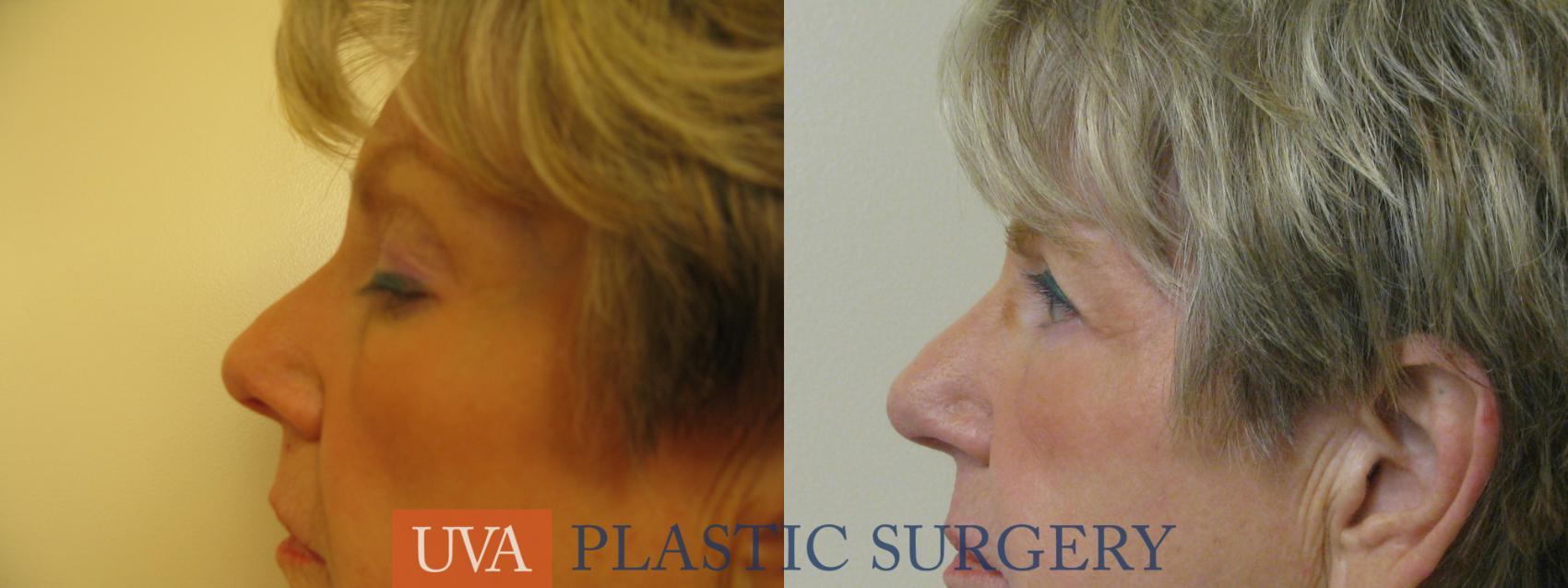 Eyelid Surgery (Blepharoplasty) Case 84 Before & After View #3 | Charlottesville & Fishersville, VA | University of Virginia Plastic Surgery