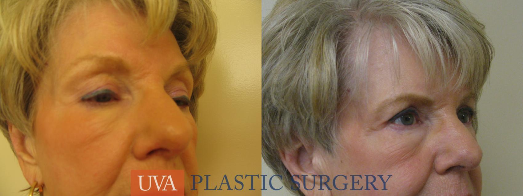 Eyelid Surgery (Blepharoplasty) Case 84 Before & After View #4 | Charlottesville & Fishersville, VA | University of Virginia Plastic Surgery