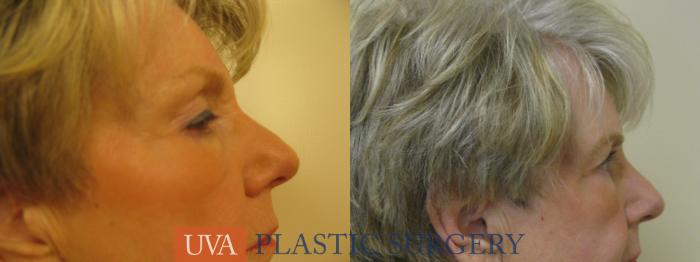 Eyelid Surgery (Blepharoplasty) Case 84 Before & After View #5 | Richmond, Charlottesville & Roanoke, VA | University of Virginia Plastic Surgery