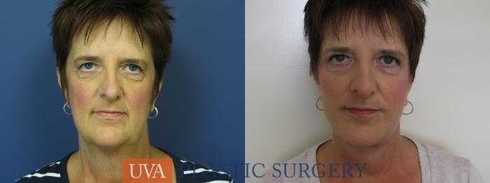 Facelift Case 111 Before & After View #1 | Richmond, Charlottesville & Roanoke, VA | University of Virginia Plastic Surgery