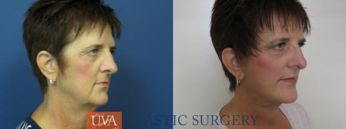 Facelift Case 111 Before & After View #2 | Richmond, Charlottesville & Roanoke, VA | University of Virginia Plastic Surgery