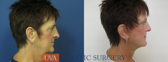 Facelift Case 111 Before & After View #3 | Richmond, Charlottesville & Roanoke, VA | University of Virginia Plastic Surgery