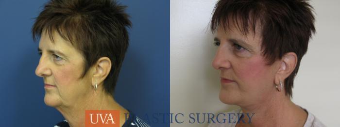 Facelift Case 111 Before & After View #4 | Richmond, Charlottesville & Roanoke, VA | University of Virginia Plastic Surgery