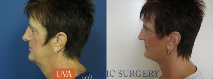 Facelift Case 111 Before & After View #5 | Richmond, Charlottesville & Roanoke, VA | University of Virginia Plastic Surgery