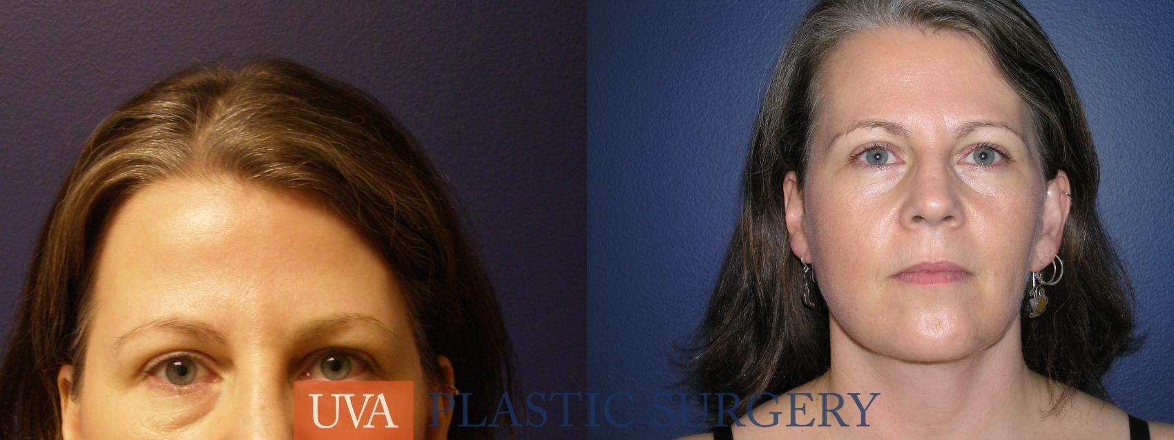 Facelift Neck Lift for Richmond Charlottesville Roanoke VA