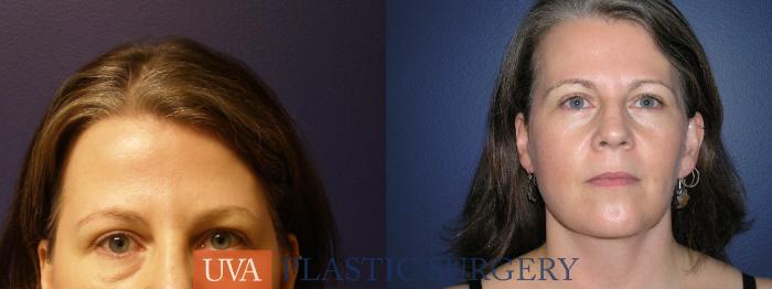 Facelift Case 9 Before & After View #1 | Richmond, Charlottesville & Roanoke, VA | University of Virginia Plastic Surgery