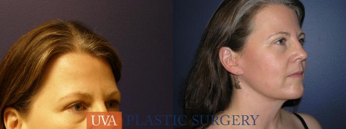 Facelift Case 9 Before & After View #2 | Richmond, Charlottesville & Roanoke, VA | University of Virginia Plastic Surgery