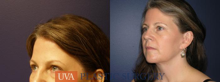 Facelift Case 9 Before & After View #3 | Richmond, Charlottesville & Roanoke, VA | University of Virginia Plastic Surgery