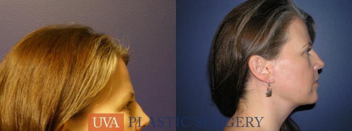 Facelift Case 9 Before & After View #4 | Richmond, Charlottesville & Roanoke, VA | University of Virginia Plastic Surgery