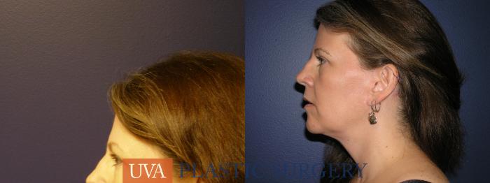 Facelift Case 9 Before & After View #5 | Richmond, Charlottesville & Roanoke, VA | University of Virginia Plastic Surgery