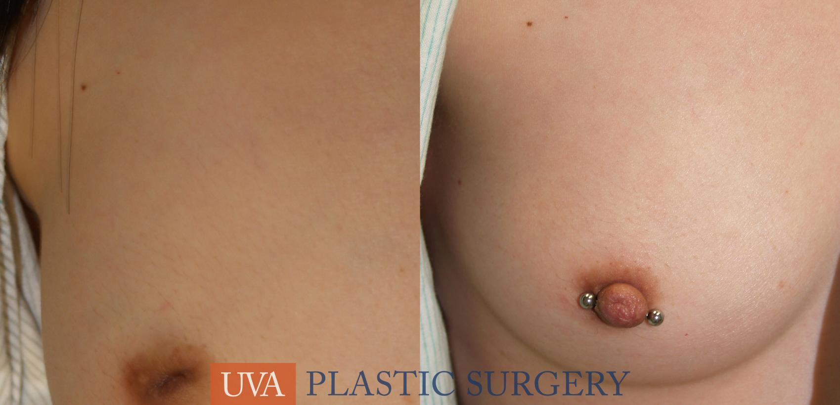 Inverted Nipple Correction Case 7 Before & After View #1 | Charlottesville & Fishersville, VA | University of Virginia Plastic Surgery