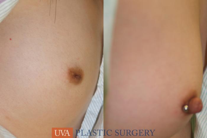 Inverted Nipple Correction Case 7 Before & After View #2 | Charlottesville & Fishersville, VA | University of Virginia Plastic Surgery