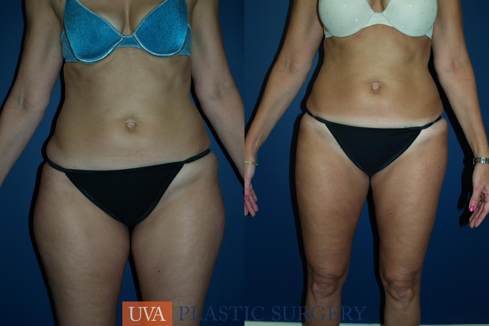 Liposuction Case 28 Before & After View #1 | Charlottesville & Fishersville, VA | University of Virginia Plastic Surgery