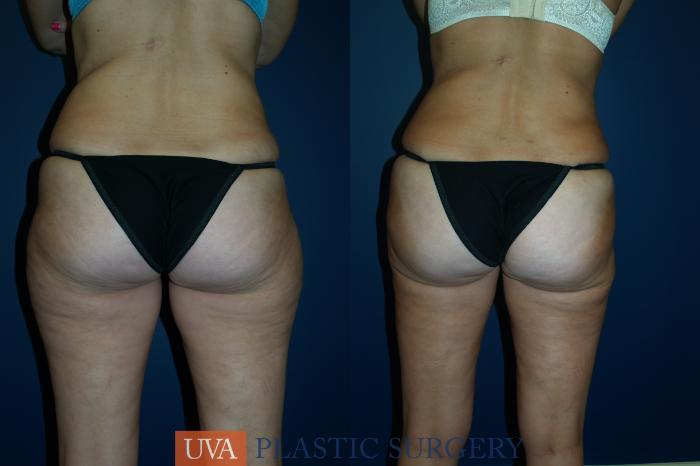 Liposuction Case 28 Before & After View #2 | Richmond, Charlottesville & Roanoke, VA | University of Virginia Plastic Surgery