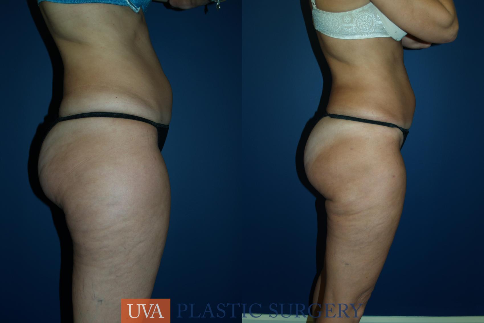 Liposuction Case 28 Before & After View #3 | Charlottesville & Fishersville, VA | University of Virginia Plastic Surgery