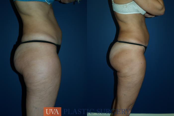 Liposuction Case 28 Before & After View #3 | Richmond, Charlottesville & Roanoke, VA | University of Virginia Plastic Surgery