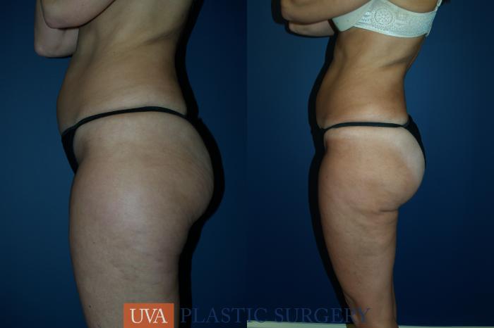 Liposuction Case 28 Before & After View #4 | Richmond, Charlottesville & Roanoke, VA | University of Virginia Plastic Surgery