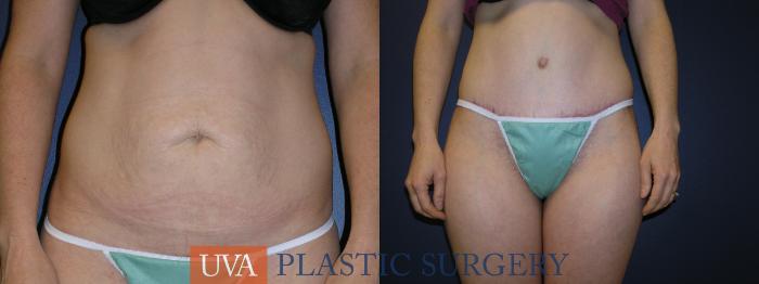 Liposuction Case 3 Before & After View #1 | Charlottesville & Fishersville, VA | University of Virginia Plastic Surgery