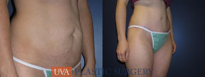 Liposuction Case 3 Before & After View #2 | Richmond, Charlottesville & Roanoke, VA | University of Virginia Plastic Surgery