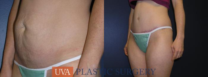 Liposuction Case 3 Before & After View #3 | Richmond, Charlottesville & Roanoke, VA | University of Virginia Plastic Surgery