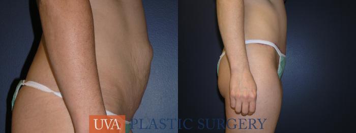 Liposuction Case 3 Before & After View #4 | Richmond, Charlottesville & Roanoke, VA | University of Virginia Plastic Surgery