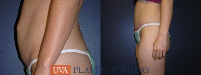 Liposuction Case 3 Before & After View #5 | Richmond, Charlottesville & Roanoke, VA | University of Virginia Plastic Surgery