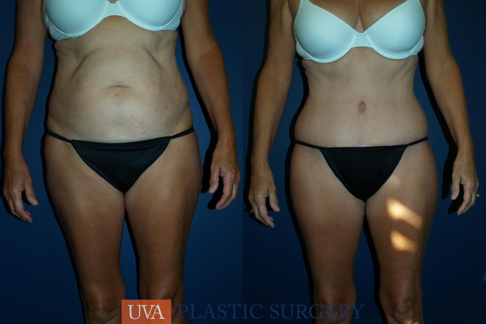 Liposuction Case 46 Before & After View #1 | Charlottesville & Fishersville, VA | University of Virginia Plastic Surgery