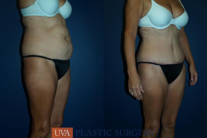 Liposuction Case 46 Before & After View #2 | Richmond, Charlottesville & Roanoke, VA | University of Virginia Plastic Surgery