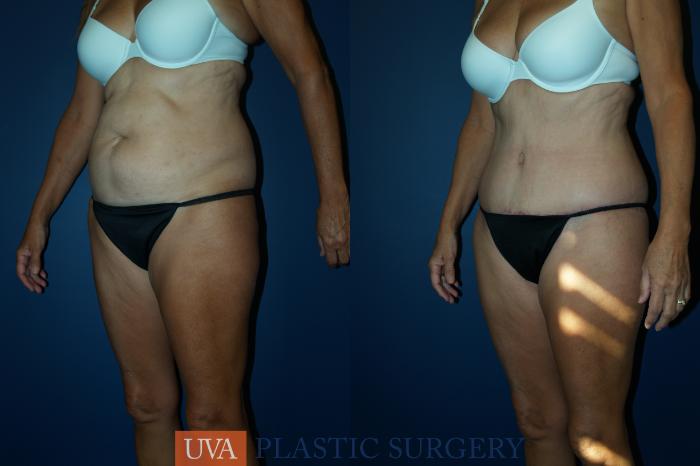 Liposuction Case 46 Before & After View #3 | Richmond, Charlottesville & Roanoke, VA | University of Virginia Plastic Surgery