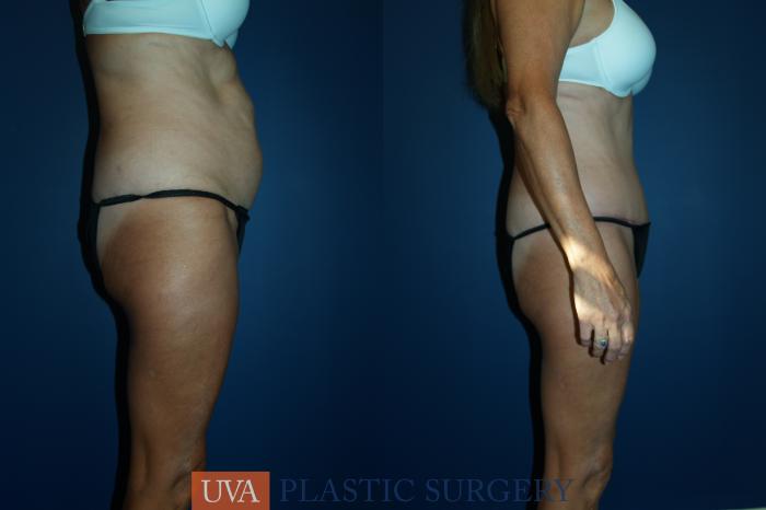 Liposuction Case 46 Before & After View #4 | Richmond, Charlottesville & Roanoke, VA | University of Virginia Plastic Surgery