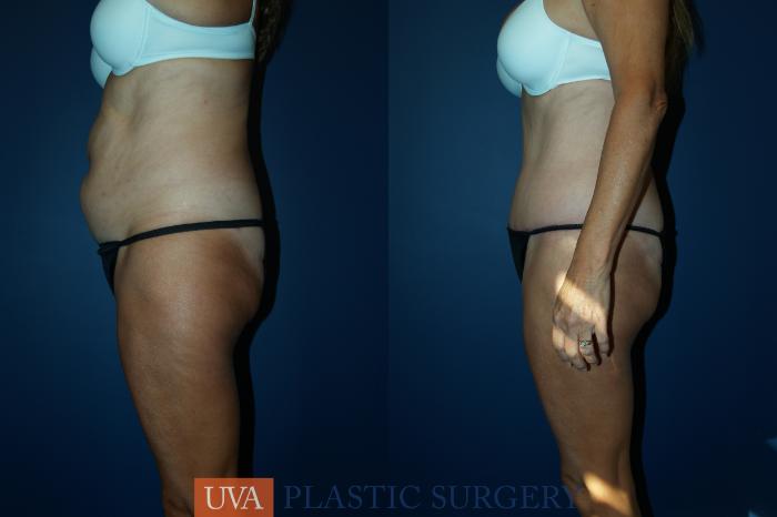Liposuction Case 46 Before & After View #5 | Richmond, Charlottesville & Roanoke, VA | University of Virginia Plastic Surgery