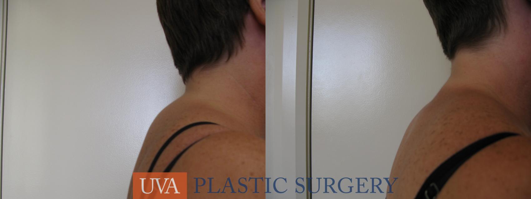 Liposuction Case 81 Before & After View #1 | Charlottesville & Fishersville, VA | University of Virginia Plastic Surgery