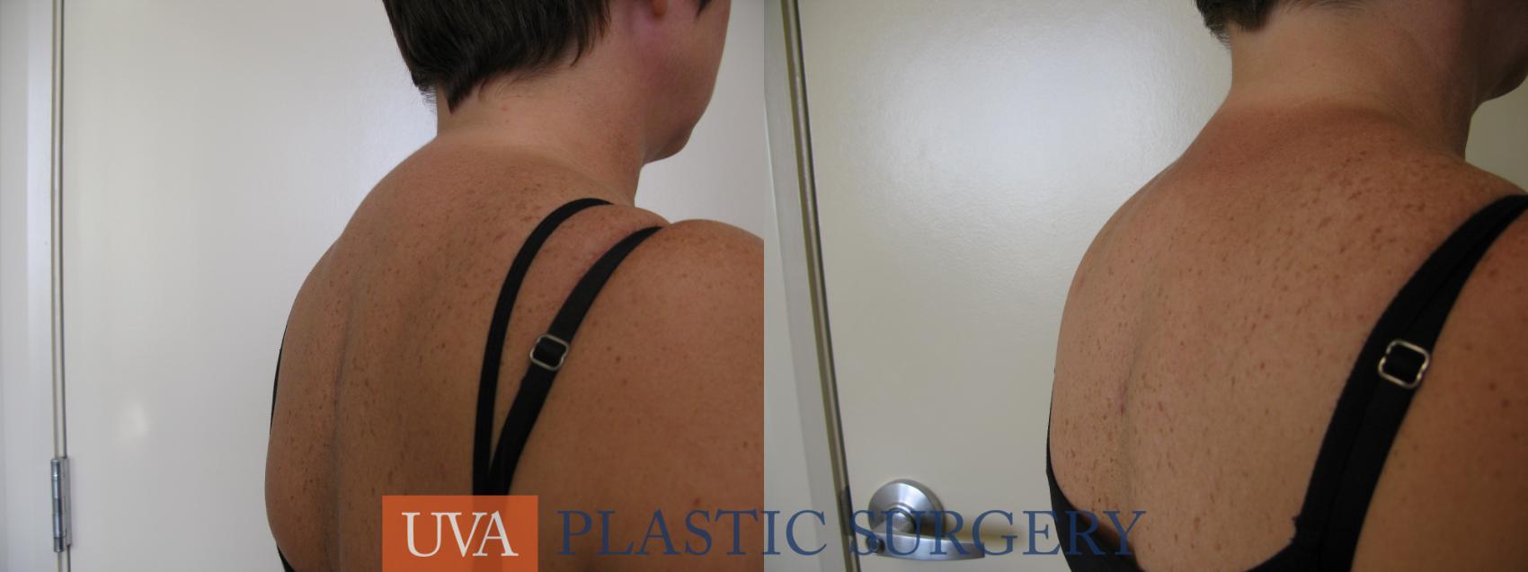 Liposuction Case 81 Before & After View #2 | Charlottesville & Fishersville, VA | University of Virginia Plastic Surgery