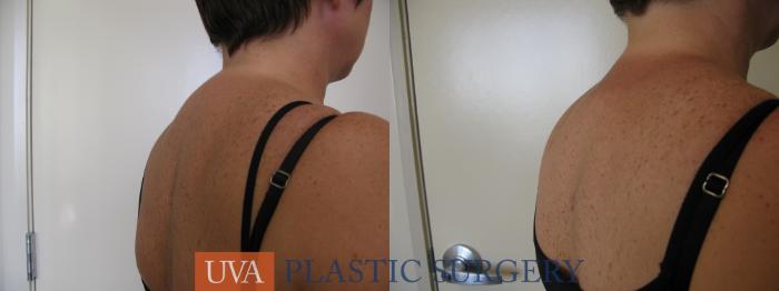 Liposuction Case 81 Before & After View #2 | Richmond, Charlottesville & Roanoke, VA | University of Virginia Plastic Surgery