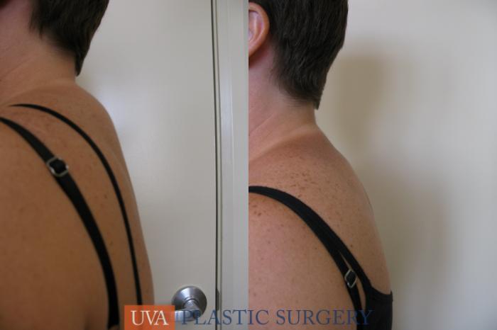 Liposuction Case 81 Before & After View #3 | Richmond, Charlottesville & Roanoke, VA | University of Virginia Plastic Surgery