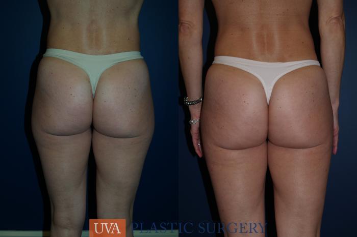 Liposuction Case 83 Before & After View #1 | Charlottesville & Fishersville, VA | University of Virginia Plastic Surgery