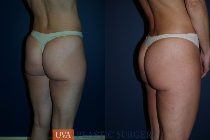 Liposuction Case 83 Before & After View #2 | Richmond, Charlottesville & Roanoke, VA | University of Virginia Plastic Surgery