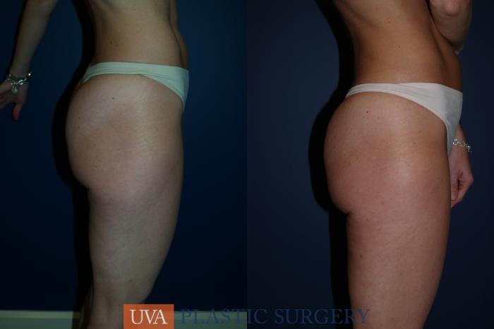 Liposuction Case 83 Before & After View #3 | Richmond, Charlottesville & Roanoke, VA | University of Virginia Plastic Surgery