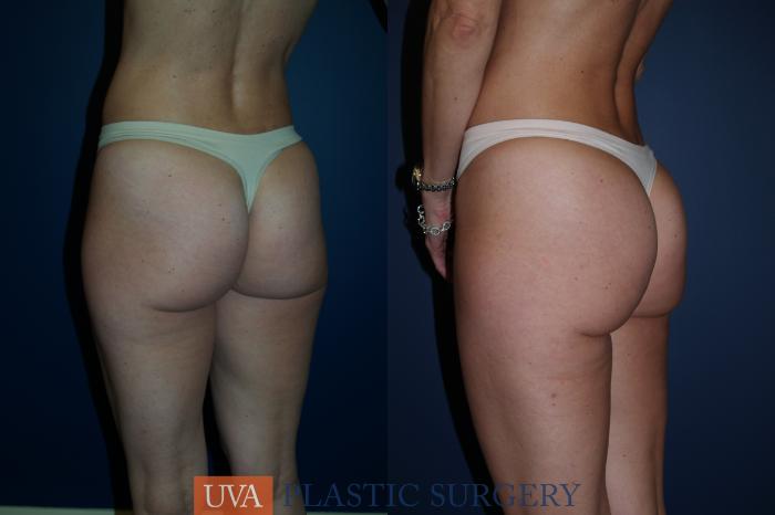 Liposuction Case 83 Before & After View #4 | Richmond, Charlottesville & Roanoke, VA | University of Virginia Plastic Surgery