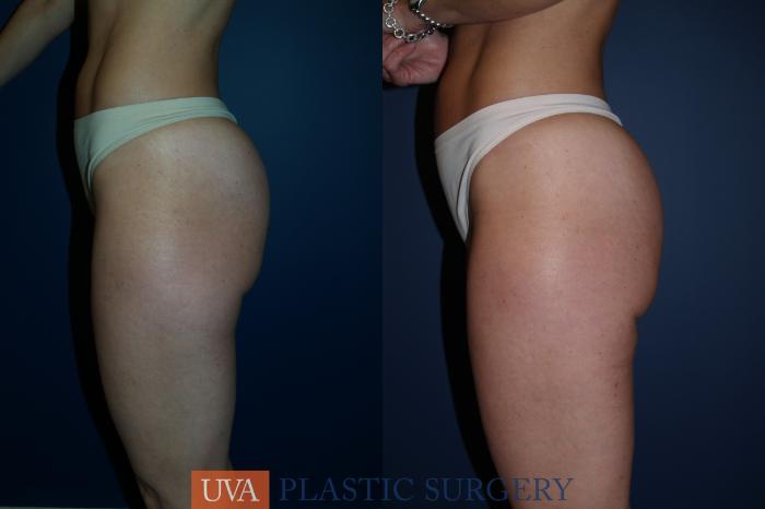 Liposuction Case 83 Before & After View #5 | Richmond, Charlottesville & Roanoke, VA | University of Virginia Plastic Surgery