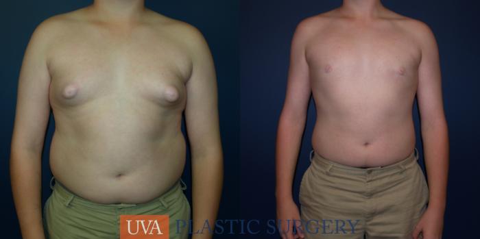Male Breast Reduction (Gynecomastia) Case 65 Before & After View #1 | Richmond, Charlottesville & Roanoke, VA | University of Virginia Plastic Surgery